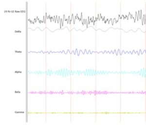 Read more about the article Können EEG-Stirnbänder Meditation messen?